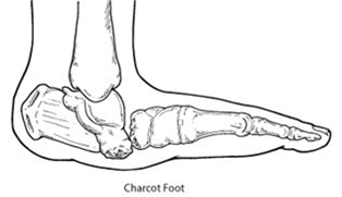 Illustration showing normal foot bone structure